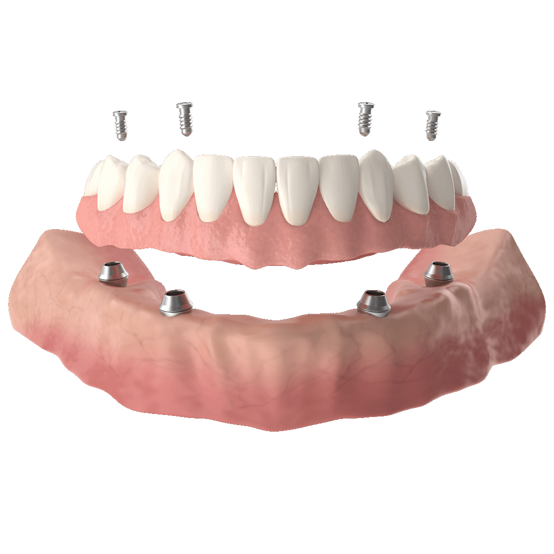 dentes de 1 dia carga imediata dentes de 1 dia carga imediata