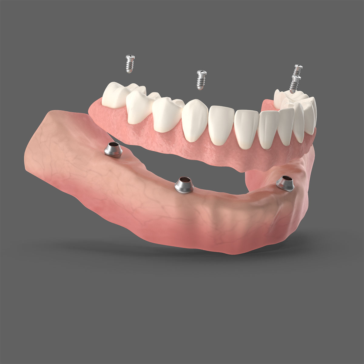 dentes em 1 dia carga imediata dentes em 1 dia carga imediata