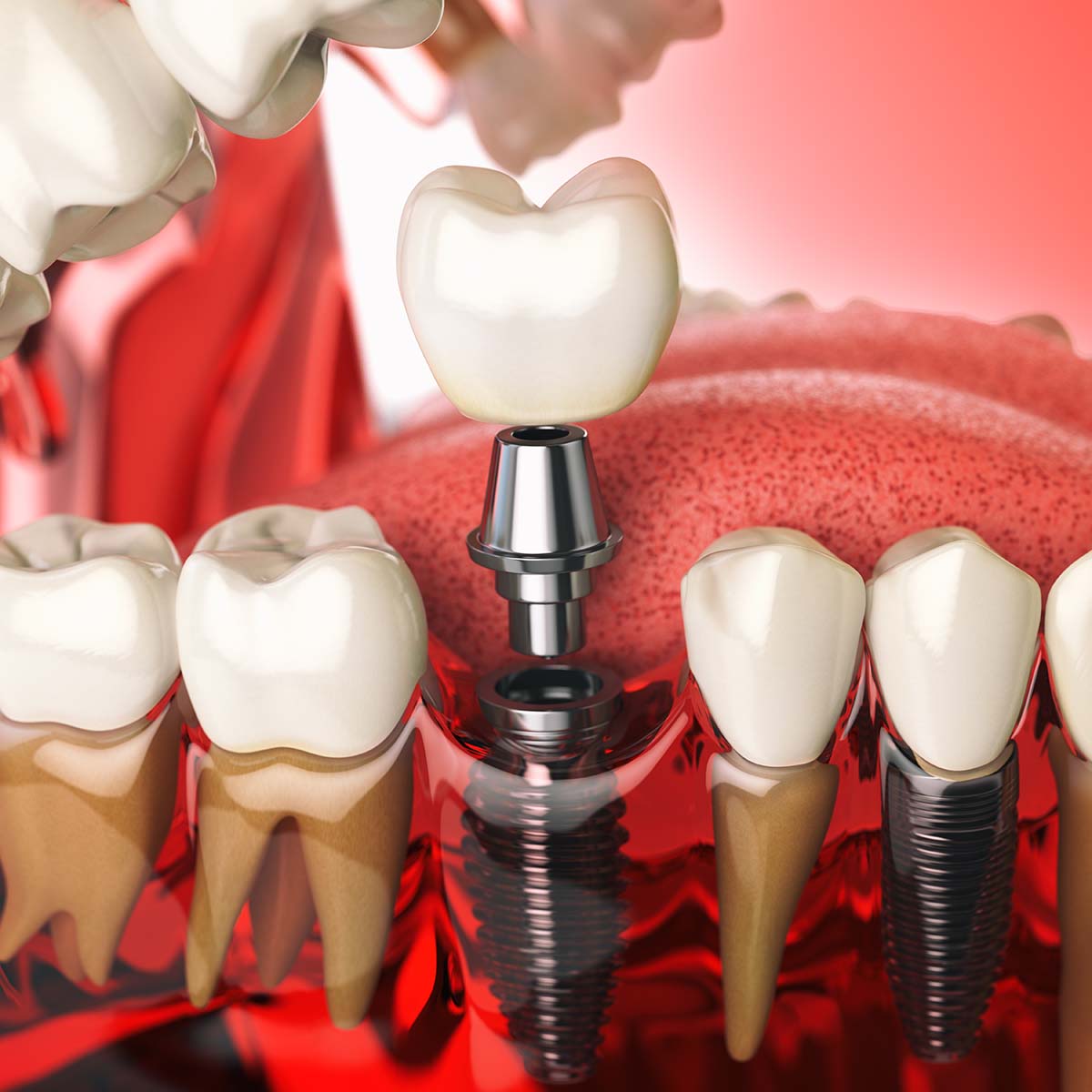 implante dentario implante dentario
