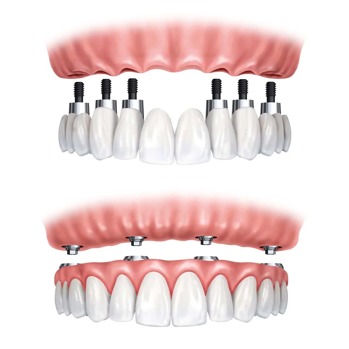implantes dentarios quem sao os candidatos ideais 1 implantes dentarios quem sao os candidatos ideais 1