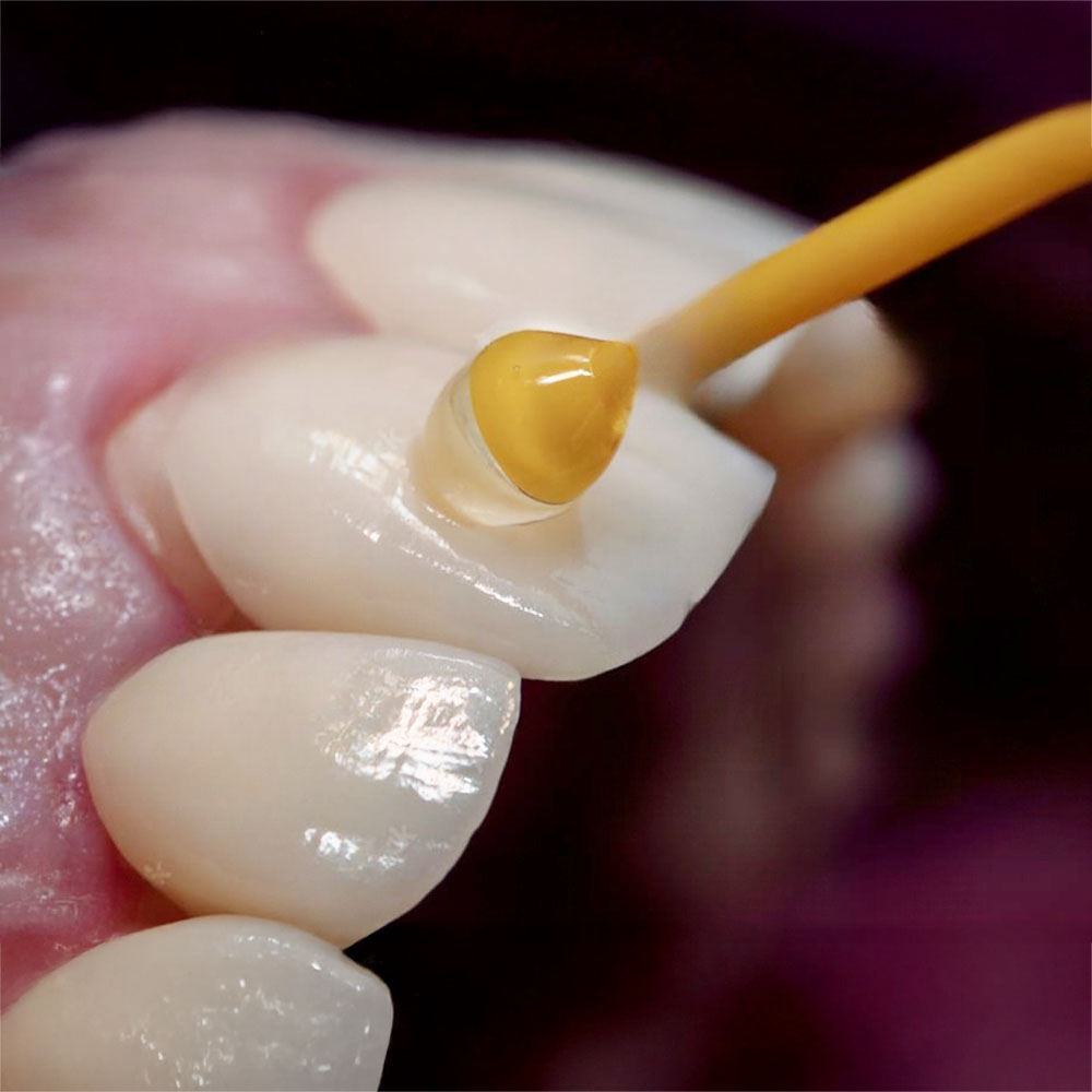 facetas dentárias