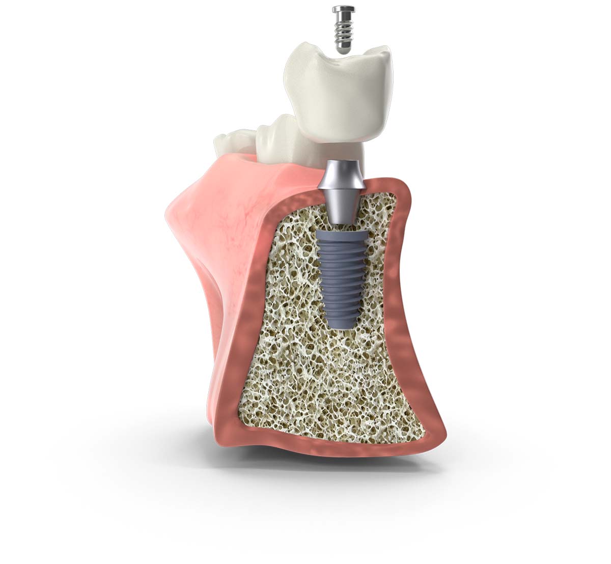 dental implant section cristiana rebelo dental implant section cristiana rebelo