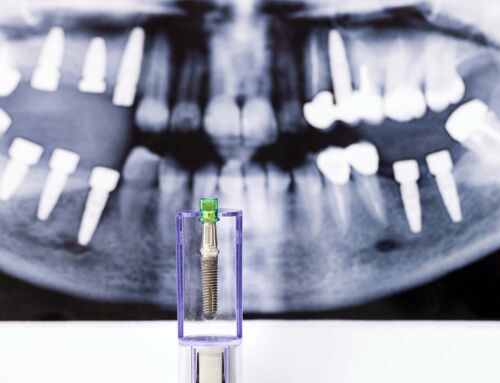 Implantes dentários doem mesmo? O que é normal sentir (e o que não é)