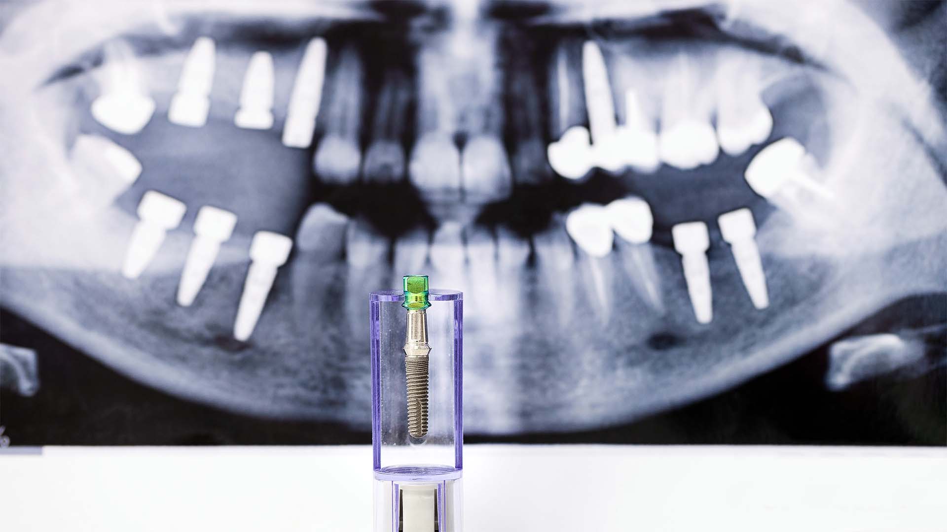 implantes dentários doem mesmo? o que é normal sentir (e o que não é) implantes dentários doem mesmo? o que é normal sentir (e o que não é)