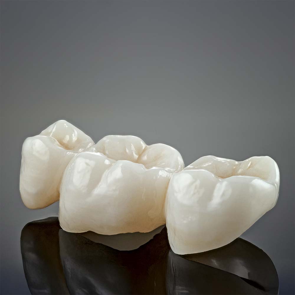 ponte ceramica com dois implantes dentario ponte ceramica com dois implantes dentario