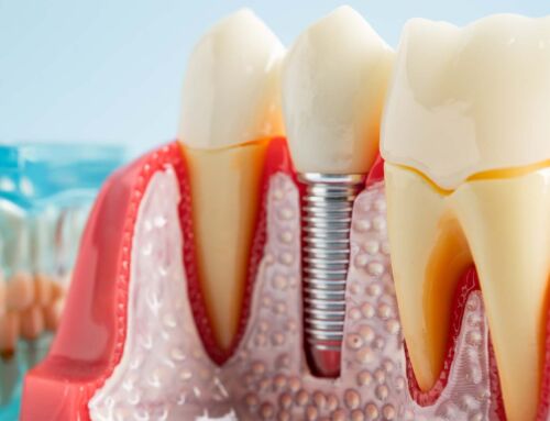 Disseram-me que “não tenho osso”: ainda dá para fazer implante?