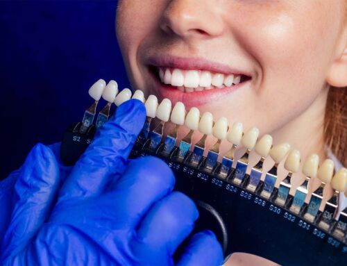 Facetas valem a pena no meu caso ou vou acabar a “manter” problemas por baixo?