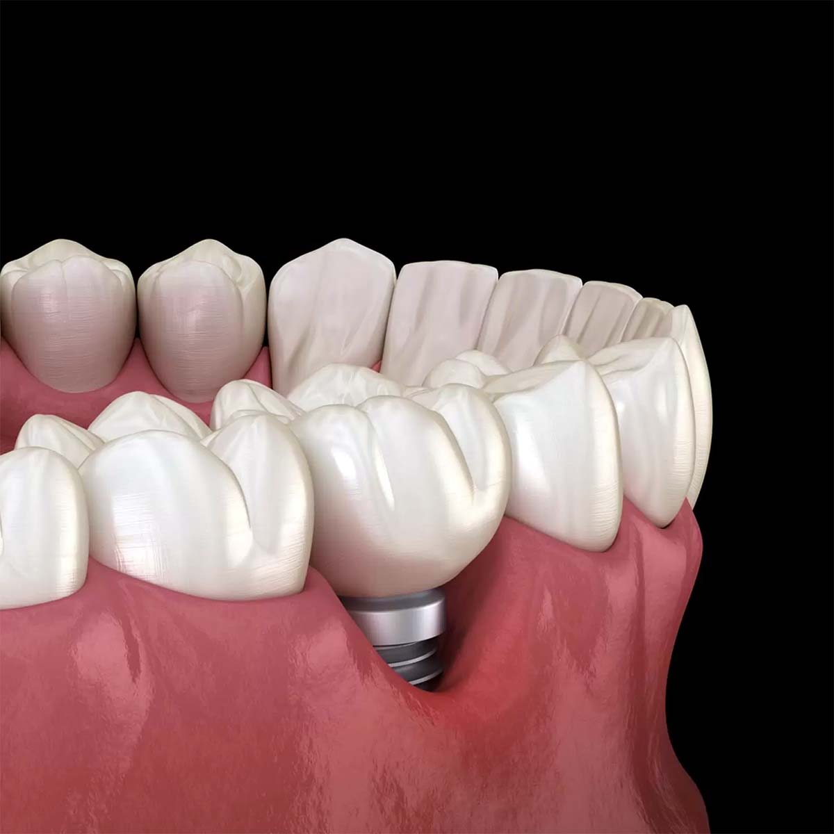 o primeiro sinal de peri implantite pode aparecer na escova. percebe o que vigiar, quem tem mais risco e quando agir antes da perda óssea