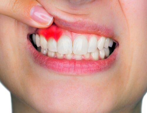 Peri-implantite: o primeiro sinal aparece na escova (e é fácil ignorar)