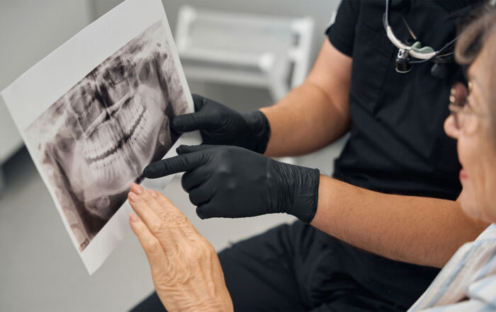 osteoperose e implantes