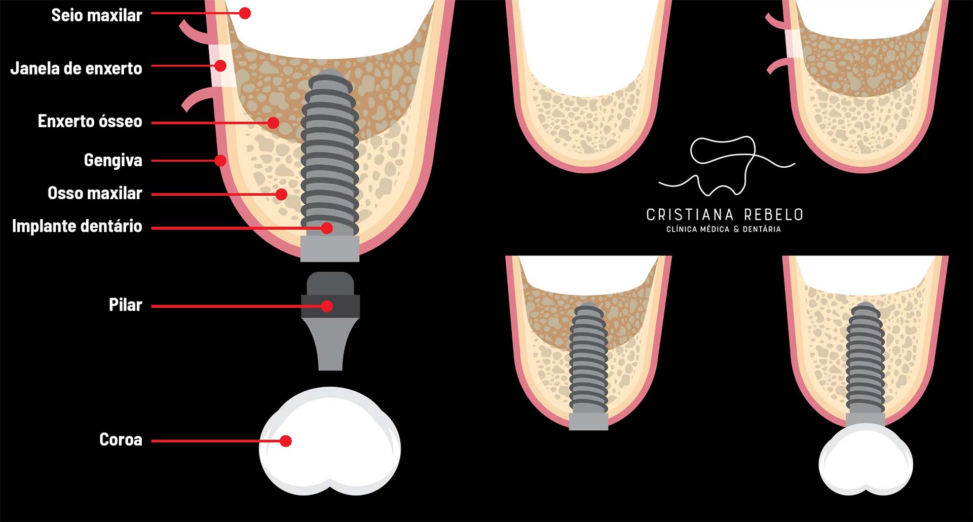 elevação seio maxilar maxillary sinus lift