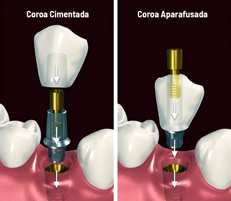 implante fixo aparafusado vs cimentado implante fixo aparafusado vs cimentado
