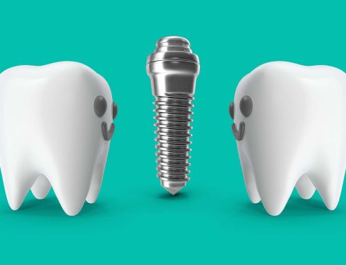 Implante unitário ou dois dentes juntos: quando “um só” não chega