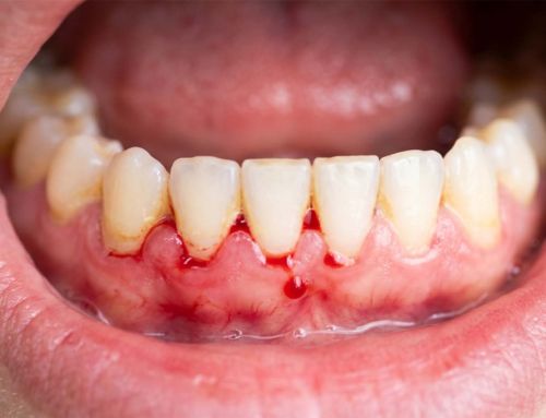Gengivas voltam a sangrar após a limpeza? O que significa