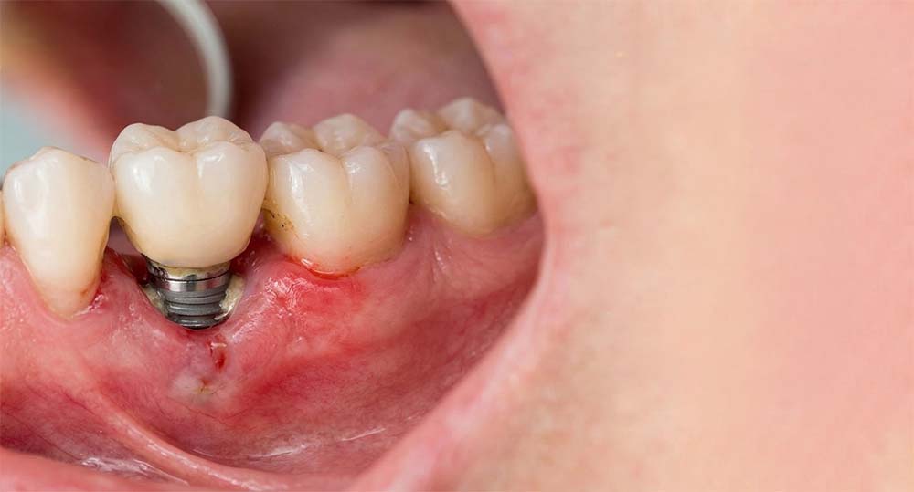 peri implantite peri implantite