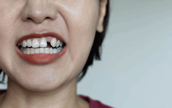 dente caiu e não dói? conheça os riscos ocultos da ausência de dor