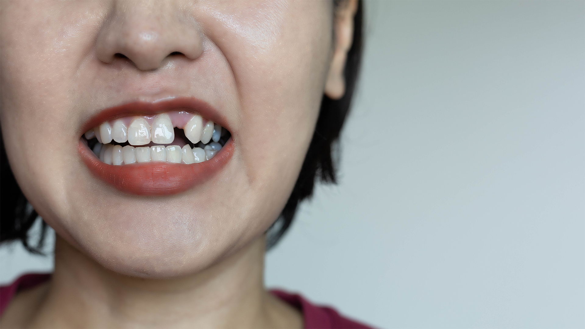 dente caiu e não dói? conheça os riscos ocultos da ausência de dor dente caiu e não dói? conheça os riscos ocultos da ausência de dor