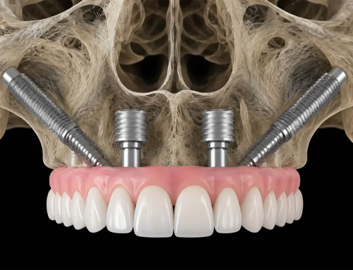 Implantes zigomáticos: a solução para quem não tem osso