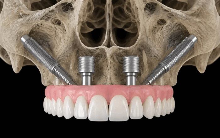 implantes zigomáticos a solução para quem não tem osso