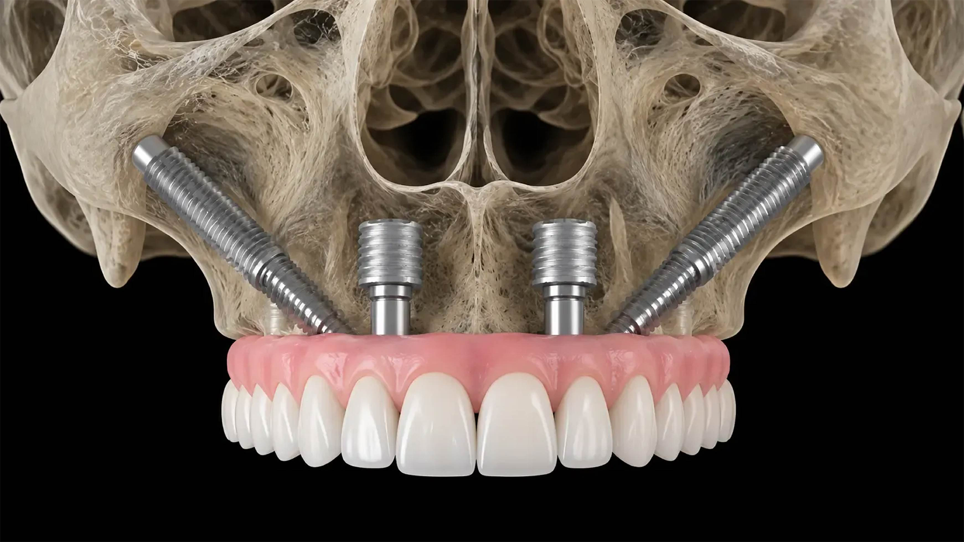 implantes zigomáticos a solução para quem não tem osso
