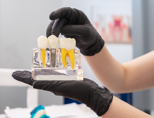 Rejeição de implantes dentários: mito ou risco real?