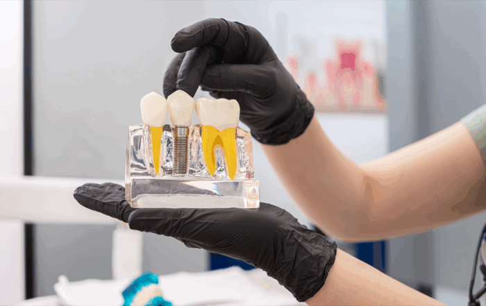 rejeição de implantes dentários mito ou risco real?