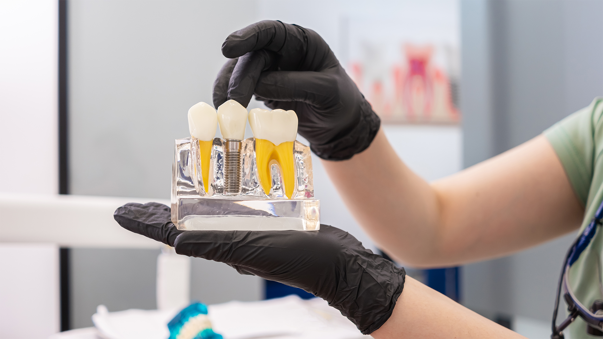 rejeição de implantes dentários mito ou risco real? rejeição de implantes dentários mito ou risco real?