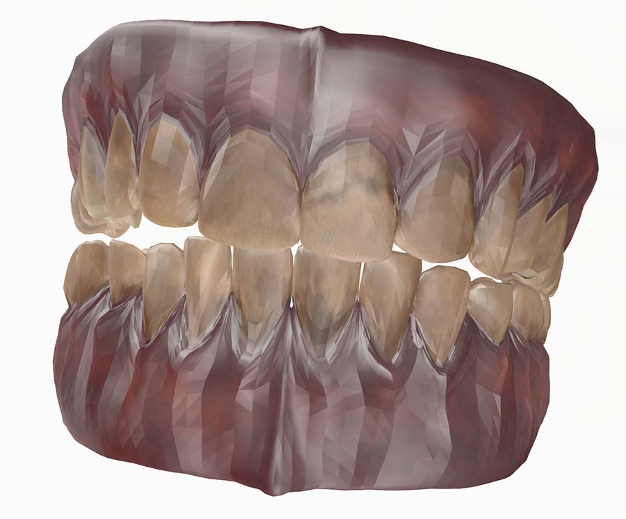 branqueamento dentário porque voltam a escurecer