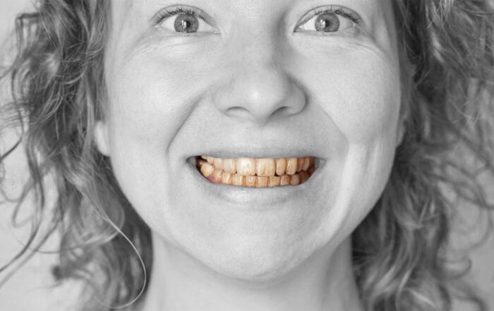 depois do branqueamento, os dentes podem voltar a escurecer. conheça as causas, os limites do tratamento e os cuidados que ajudam a manter a cor