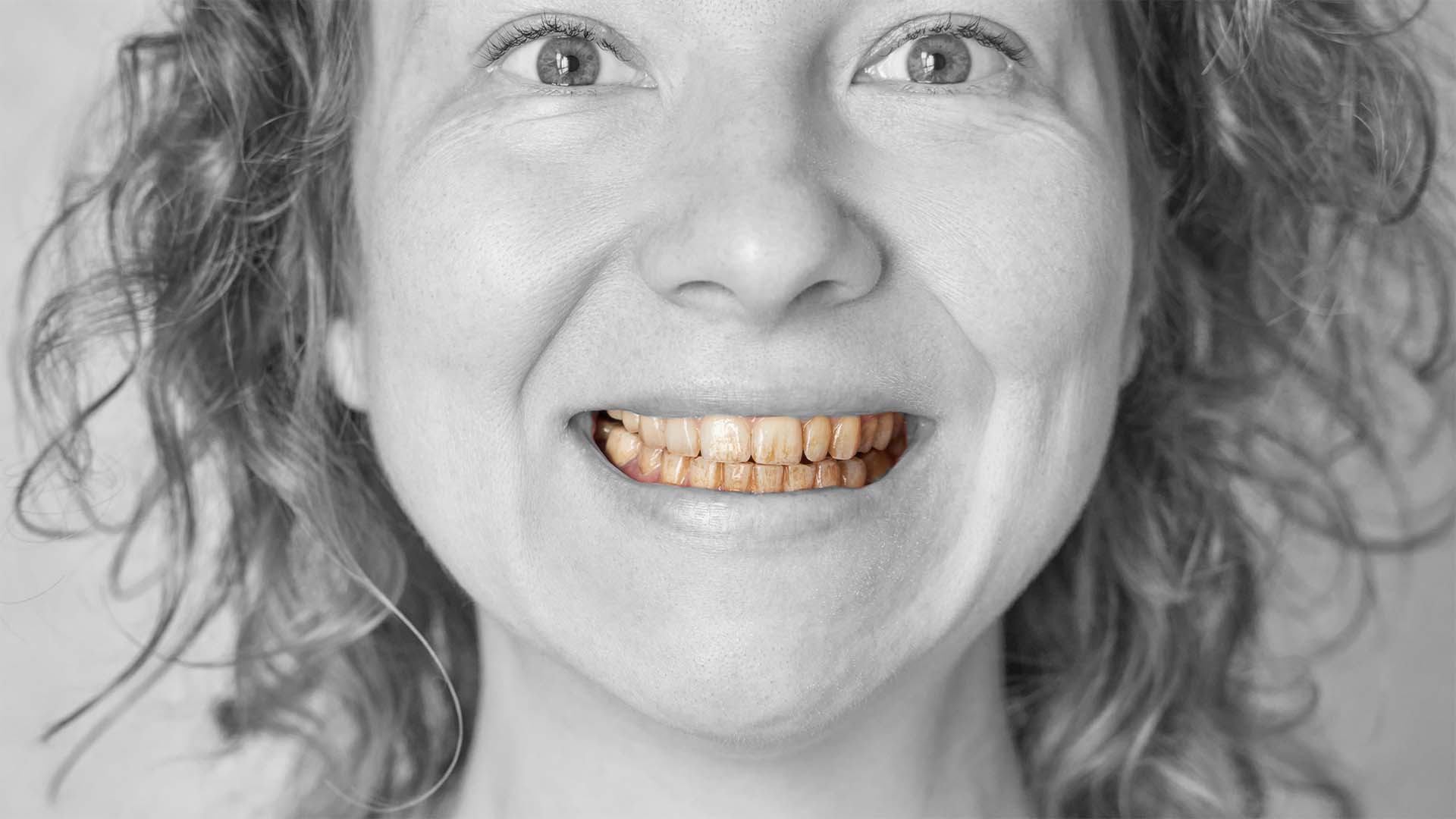 depois do branqueamento, os dentes podem voltar a escurecer. conheça as causas, os limites do tratamento e os cuidados que ajudam a manter a cor