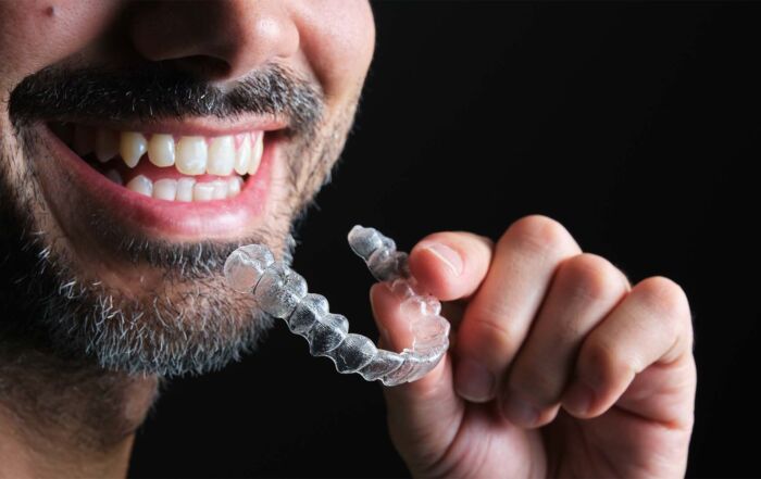 os alinhadores invisíveis podem corrigir dentes desalinhados em adultos. conheça as indicações, limites, duração e importância da contenção