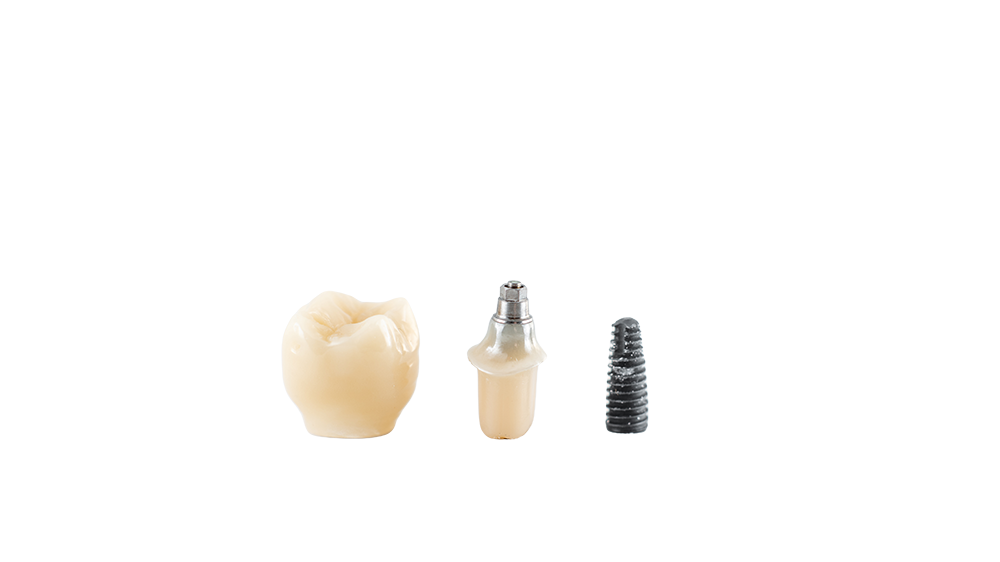 quanto tempo dura um implante dentário?