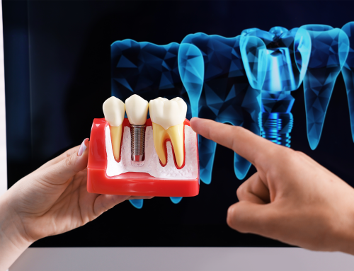Quanto tempo dura mesmo um implante dentário? O fator humano na longevidade