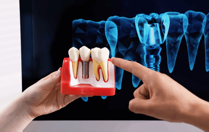 quanto tempo dura um implante dentário?1