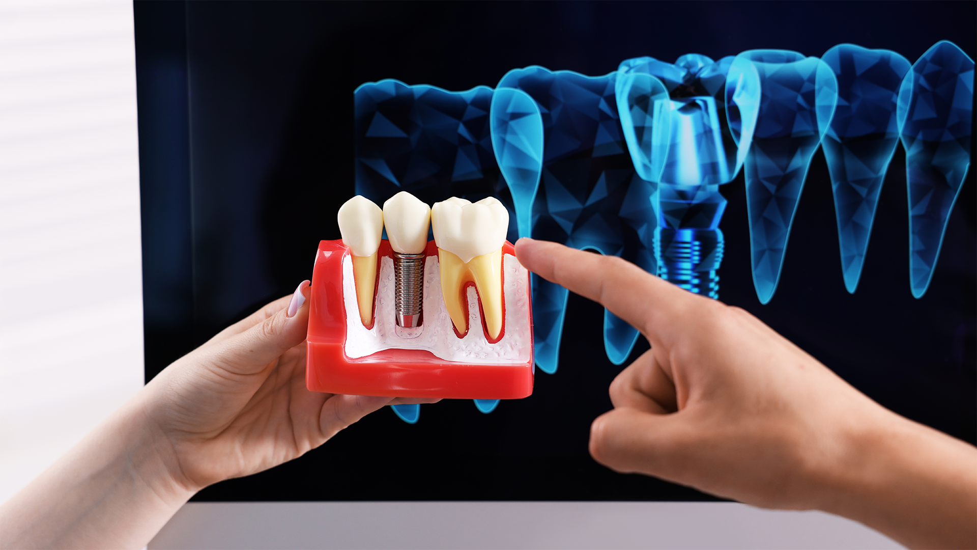 quanto tempo dura um implante dentário?1